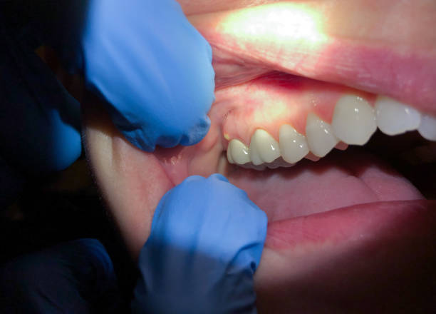 Best Emergency Dental Services for Seniors in Narrows, VA